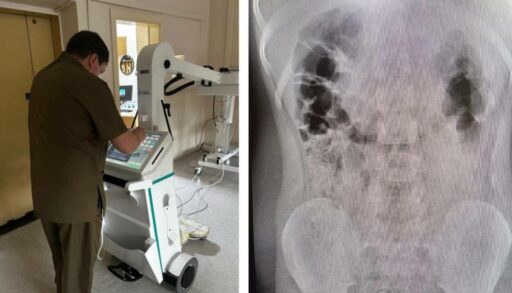 В Тюменской области 6-летний мальчик пожаловался, что проглотил металлический шарик