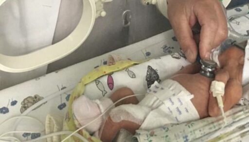 Тюменские кардиохирурги провели сложнейшую операцию на открытом сердце новорожденному