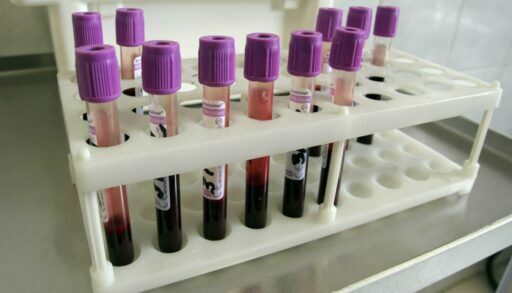 Более 500 тюменцев прошли анонимный тест на ВИЧ