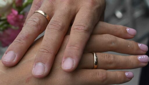 Ишимские стоматологи помогли девушке снять обручальное кольцо, впившееся в палец