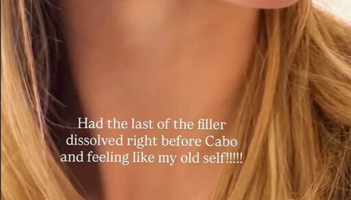 Модель Брукс Нейдер показала лицо после удаления филлеров из губ