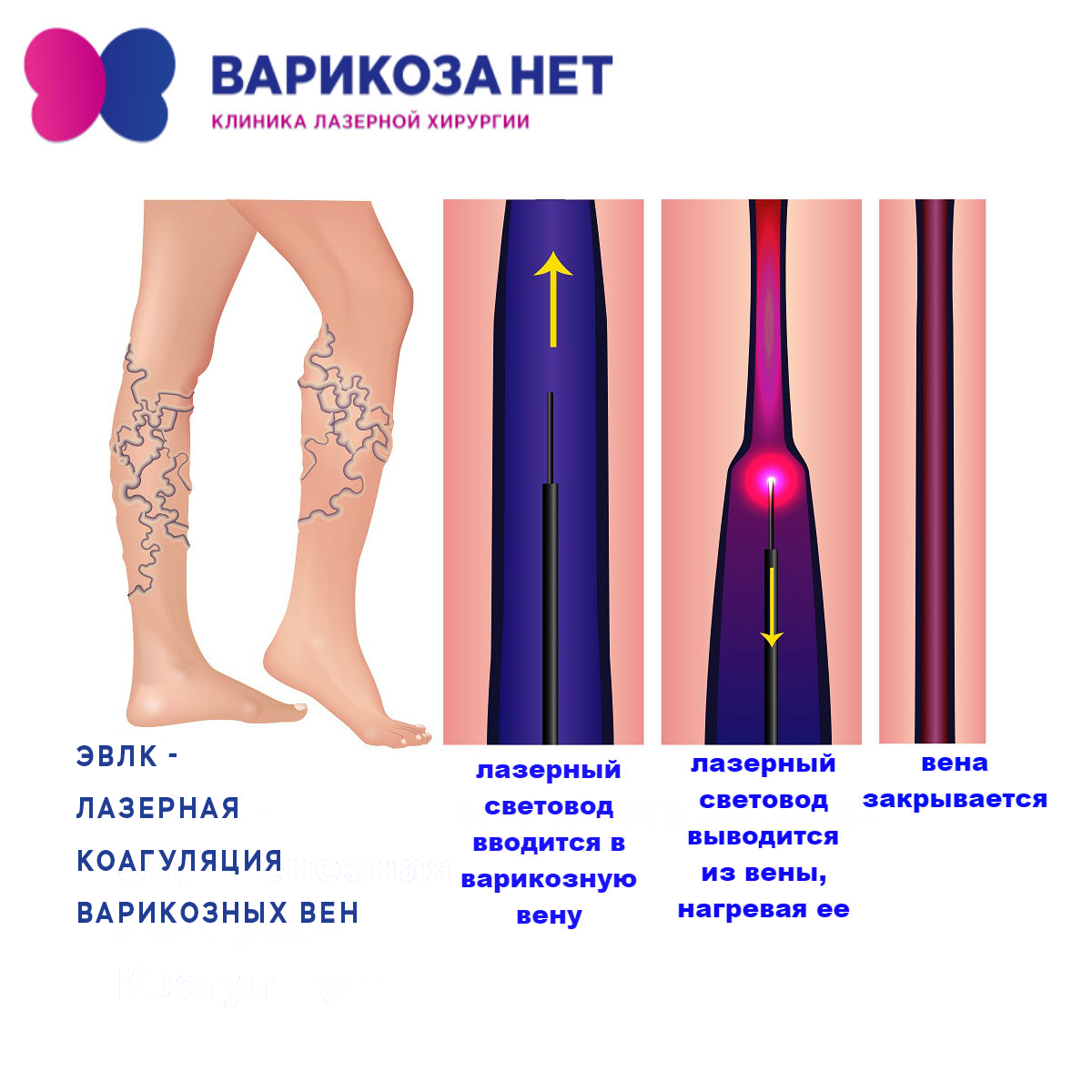Лечение вен на ногах цена. Эндовазальная лазерная облитерация вен. Эндовенозная лазерная коагуляция. Эндовенозная лазерная коагуляция вен нижних конечностей.