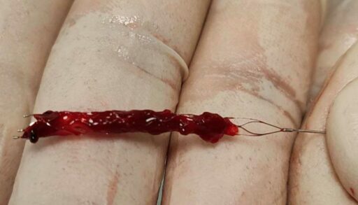 Тобольские врачи спасли молодого пациента с обширным инсультом