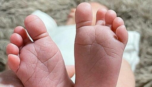 В Тюменской области родились малыши с альбинизмом(1)